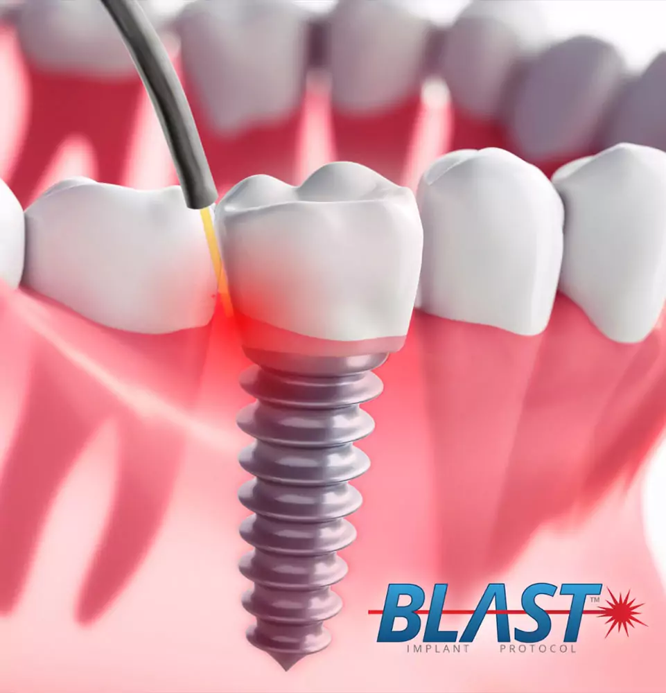 BLAST Implant Protocol at Crawford Implant Dentistry