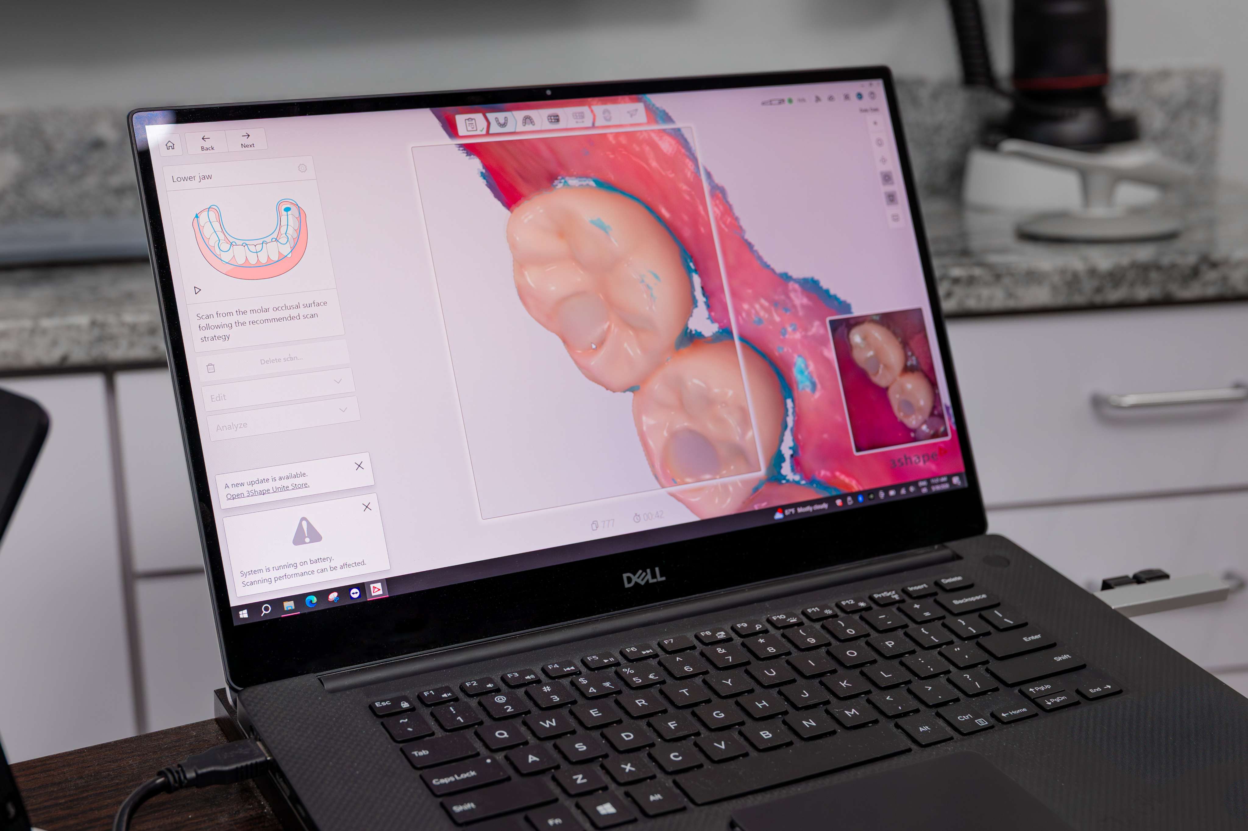 Digital scanner for precise dental impressions