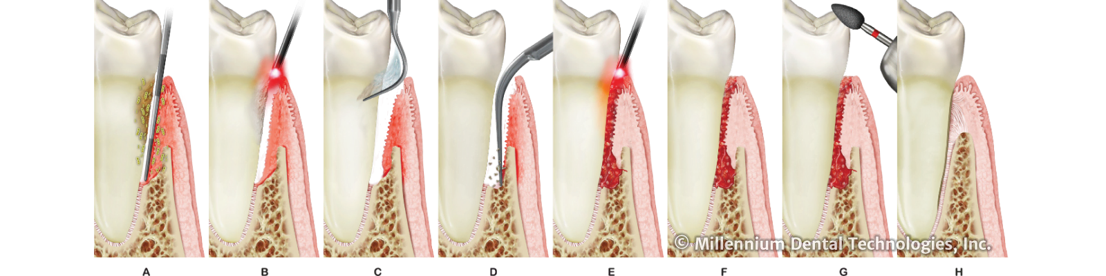 LANAP treatment protocol steps A through H